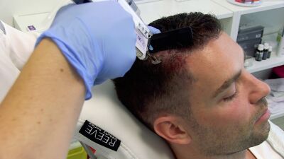 Mesotherapie tegen haaruitval