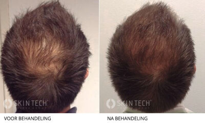 Mesotherapie haar ervaringen