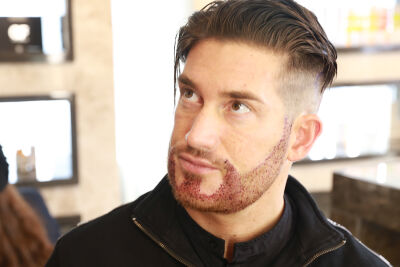 Baardtransplantatie ervaringen