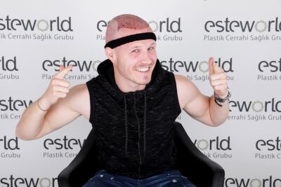 FUE haartransplantatie kosten