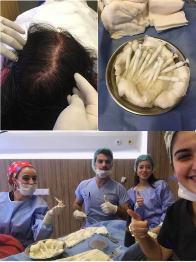 DHI haartransplantatie in Turkije bij Esteworld