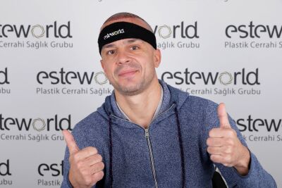 Voor haartransplantatie naar Turkije