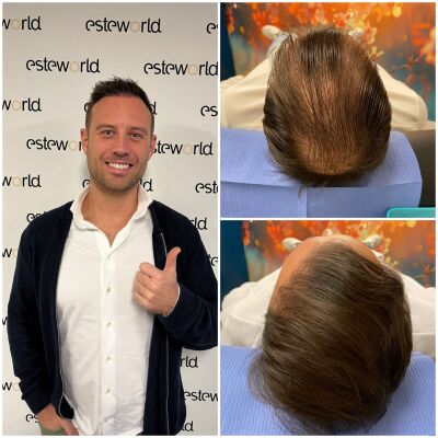 Xl hair in combinatie met een haartransplantatie?