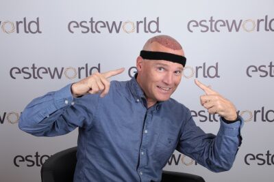 Kom ik in aanmerking voor een haartransplantatie?