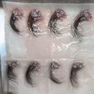 Lang haar Haartransplantatie