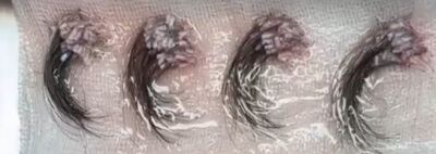 Haartransplantatie met lang haar voor vrouwen – volledig zonder scheren