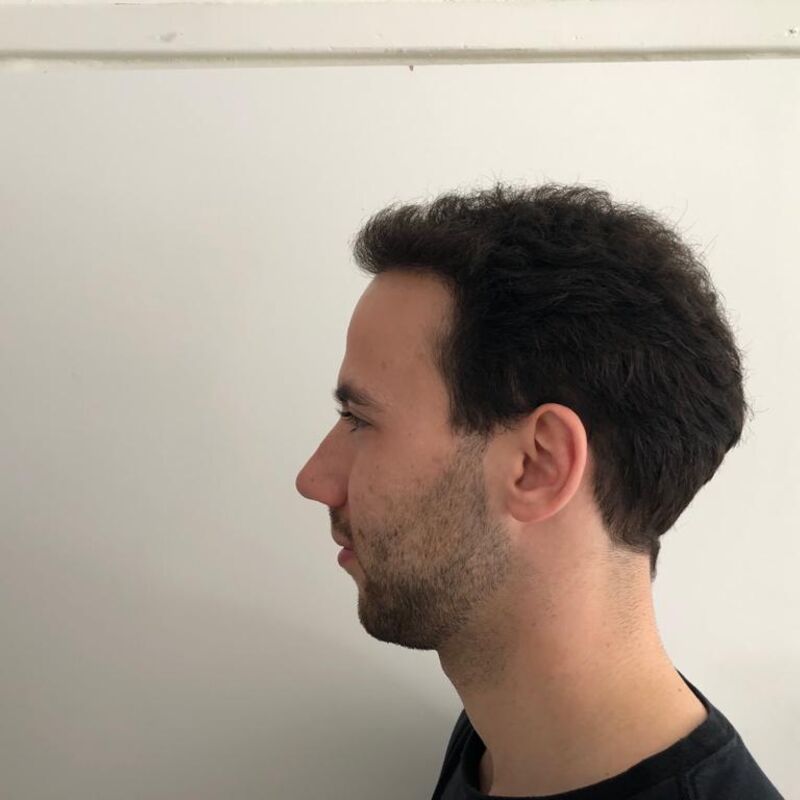 Jelmer, 100% vertrouwen in haartransplantatie resultaat