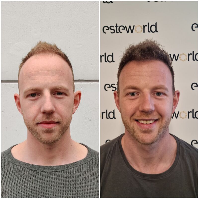 Vooraanzicht voor en na de haartransplantatie