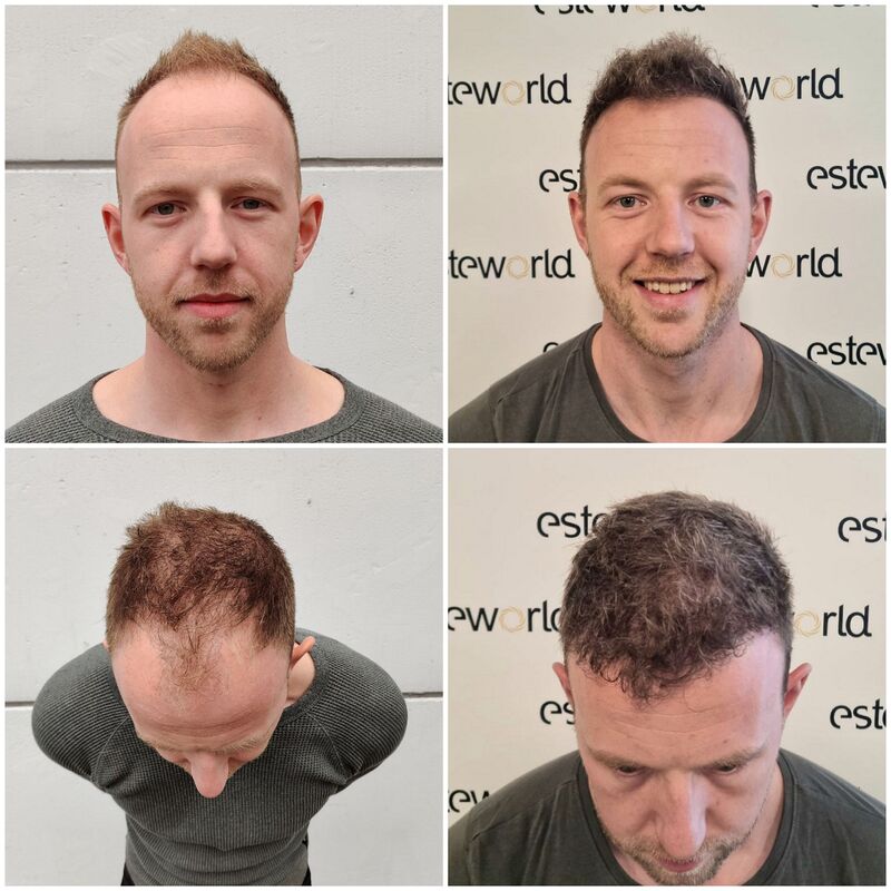 Voor en na 11 maanden na de haartransplantatie