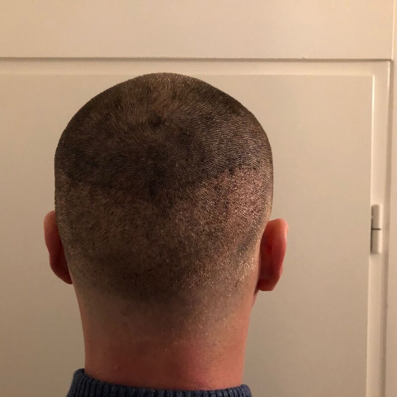 Kaal worden accepteren of actie. Voor mij Actie!