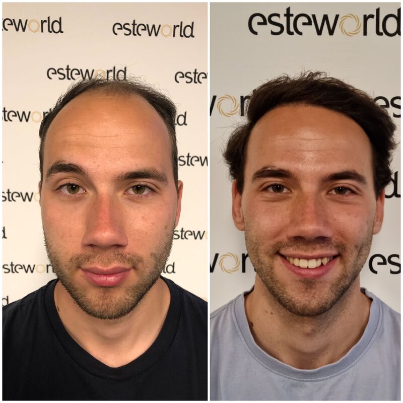 Jelmer, 100% vertrouwen in haartransplantatie resultaat