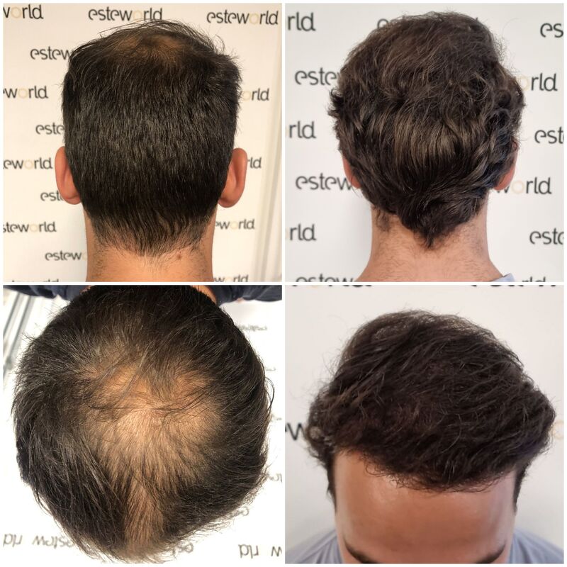 Jelmer, 100% vertrouwen in haartransplantatie resultaat