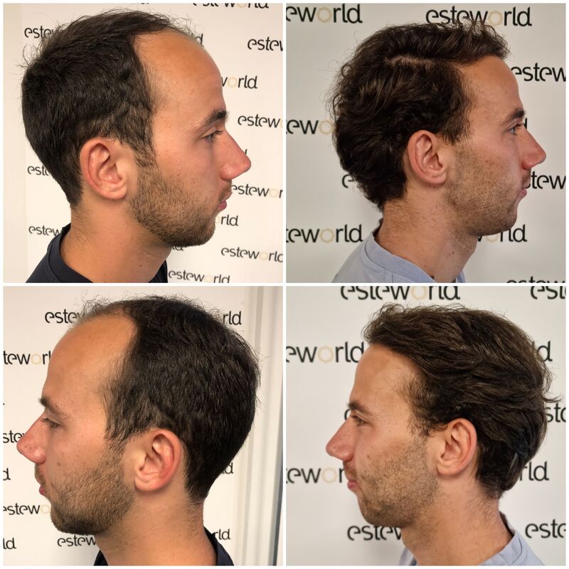 Jelmer, 100% vertrouwen in haartransplantatie resultaat