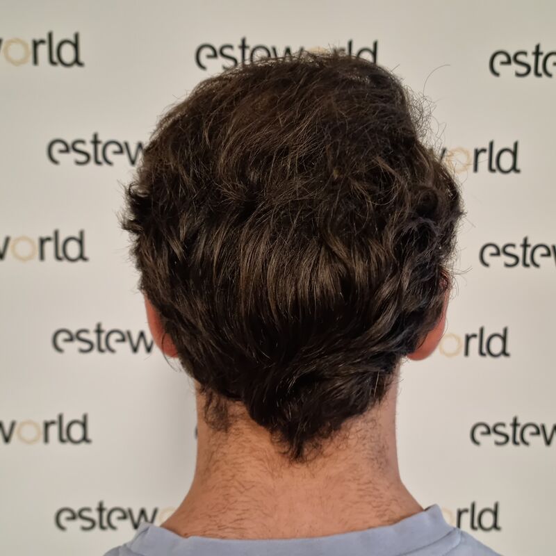 Jelmer, 100% vertrouwen in haartransplantatie resultaat