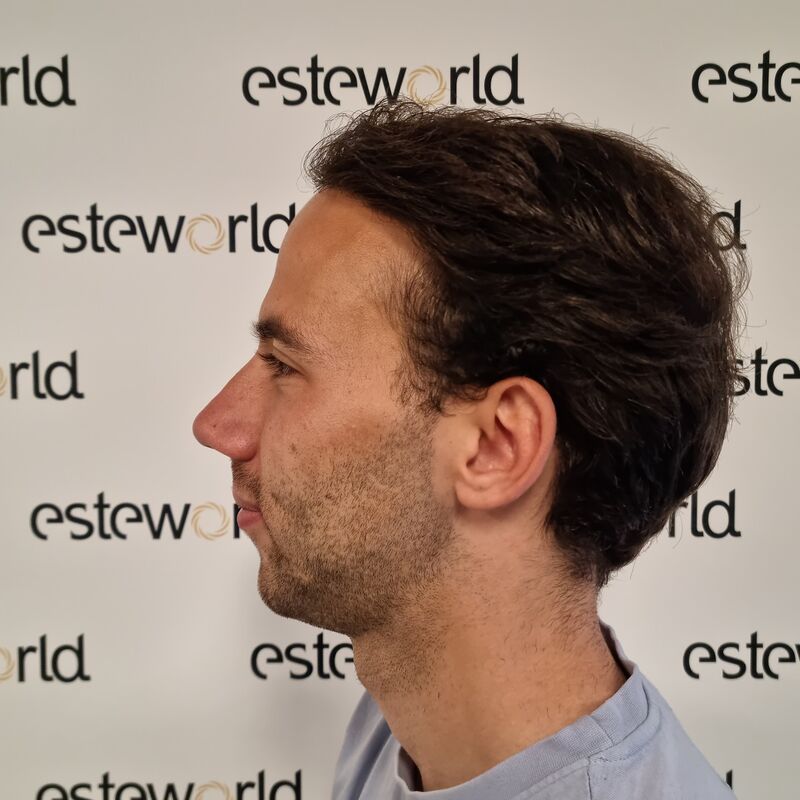 Jelmer, 100% vertrouwen in haartransplantatie resultaat